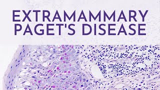 Extramammary Pagets Disease  Pathology mini tutorial [upl. by Osher]