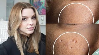 Esthetician Discusses How To Eliminate Pitted Acne Scars [upl. by Cchaddie]