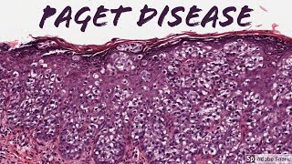 Extramammary Paget Disease 5Minute Pathology Pearls [upl. by Einafets999]