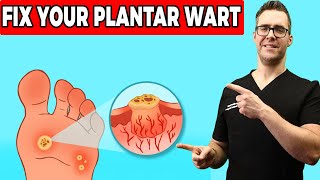 Plantar Warts Removal at Home Treatment Foot amp Toe Wart Remedies [upl. by Epoh]