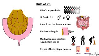 Meckel’s Diverticulum [upl. by Pasco]