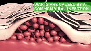 What are plantar warts [upl. by Alexio]