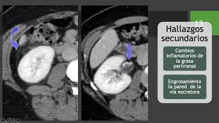 Pielonefritis Aguda Crónica Xantugranulomatosa Enfisematosa y Absceso Renal [upl. by Whiteley902]