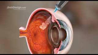 Intravitreal Injection Animation HD [upl. by Ronyar]