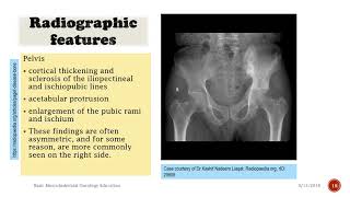 Pagets Disease How to Recognize Medical Documentary [upl. by Berners]