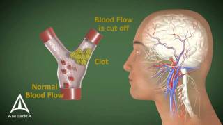 Stroke  3D Medical Animation [upl. by Viridis163]