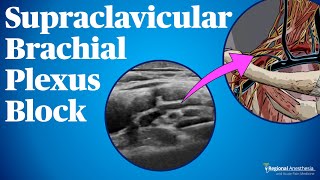 Supraclavicular Brachial Plexus Block [upl. by Imogen]