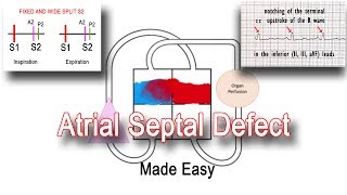 Ventricular Septal Defects by D Bailly  OPENPediatrics [upl. by Eldrida667]