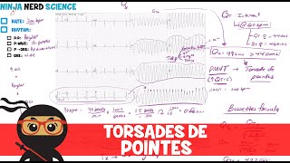 Rate and Rhythm  Torsades de Pointes [upl. by Paehpos]