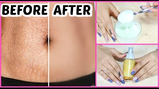 DIY STRETCH MARKS Removal Cream  Guaranteed Results In 6 Weeks  Anaysa [upl. by Myke]