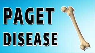 Pagets Disease [upl. by Esinyl]