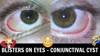 Blepharitis red swollen eyelids Causes Symptoms Treatments [upl. by Ekyt]