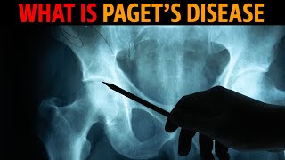 What is Pagets disease [upl. by Erodisi]